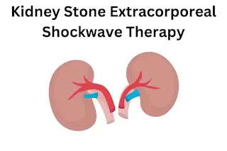 Kidney Stone Extracorporeal Shockwave Therapy