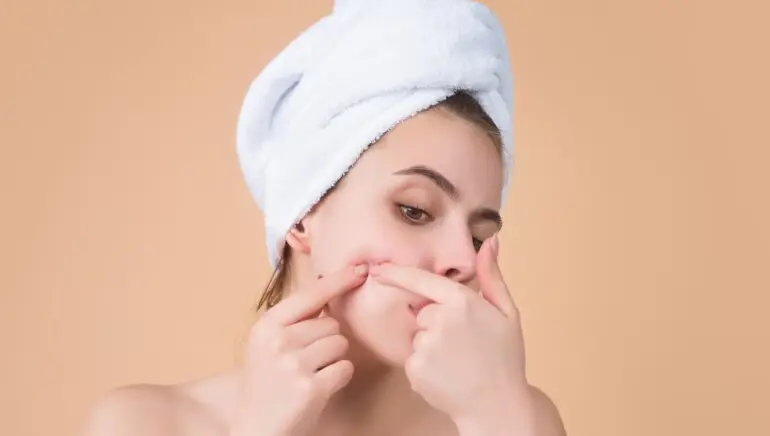 5 Simple At-Home Methods to Remove Cheek Blackheads