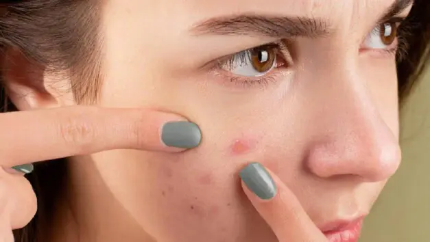 Pregnancy acne: Why does it happen 1?